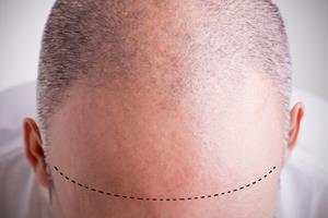  جلوگیری از ریزش مو با مسدود کردن انقباضات "غلاف پوستی"