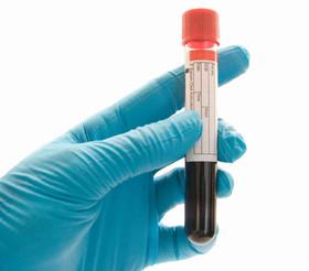 ابداع آزمایش خون برای تشخیص پنج سرطان مرگبار 