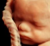 یافته‌های پژوهشگران کشور درباره تأثیر کمبود ویتامین D در سقط‌ مکرر جنین 