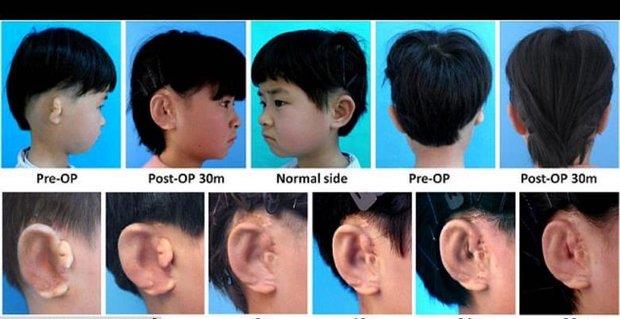 محققان چینی برای ۵ کودک گوش ساختند