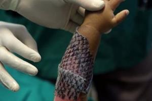 پوست ماهی تیلاپیا، راهی تازه برای درمان سوختگی
