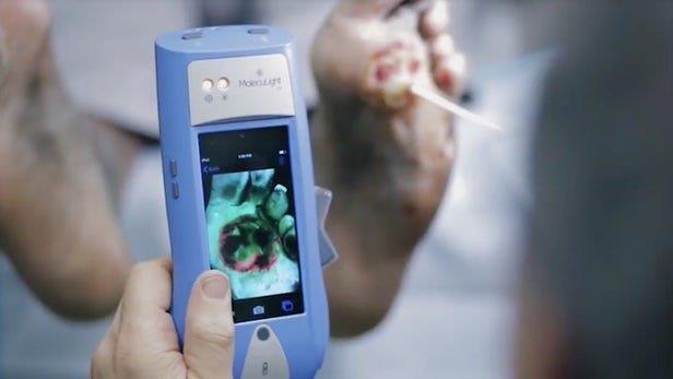  دستگاهی که میزان باکتری را در زخم‌ها نشان می‌دهد