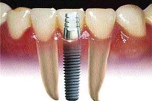 95 درصد موفقیت باز سازی استخوان دندان با ایمپلنت