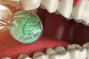  تاثیر باکتری‌های دهانی بر افزایش التهاب روده