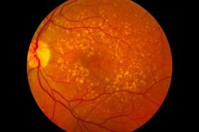 نقص عملکرد پروتئین تنظیم سیستم ایمنی علت شایع نابینایی در بزرگسالان