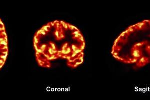 چگونه آلزایمر سبب تغییر شکل مغز می‌شود 