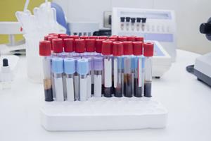 تشخیص اختلال دو قطبی با یک آزمایش خون ساده