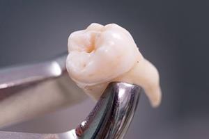 درمان حفره‌های دندان بدون پر کردن