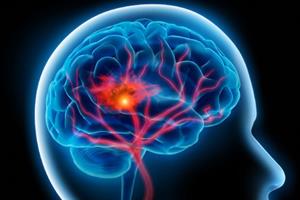 همودیالیز می‌تواند سبب افت عملکرد مغز شود
