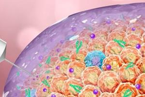  پیشگیری از رشد تومورهای سرطانی با داربست هیدروژل