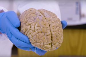  وضعیت اهدای مغز در کشورهای دیگر چگونه است؟