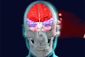  توسعه مدل مجازی مغز انسان برای تخمین آسیب‌های مغزی