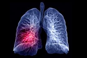 سلول‌های سرطان ریه، کبد را برای تامین سوخت خود به کار می‌گیرند!