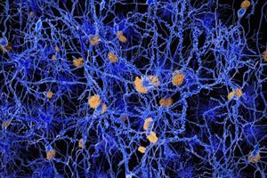  نشانه اولیه آلزایمر در مغز کشف شد