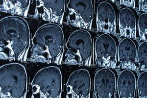  تعیین میزان آسیب‌های مغزی با هوش مصنوعی