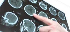 زنان آسیب‌دیده از سکته مغزی، دیرتر بهبود پیدا می‌کنند 
