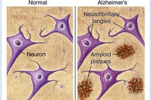 مشاهده نشانه‌های آلزایمر، 50 سال قبل از بروز بیماری 