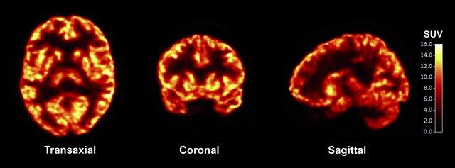 چگونه آلزایمر سبب تغییر شکل مغز می‌شود 
