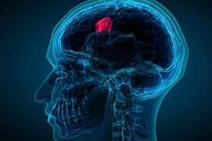  تشخیص تومور مغزی تهاجمی با یک آزمایش ساده