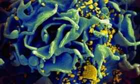  شناسایی یک التهاب جدید در افراد مبتلا به ایدز