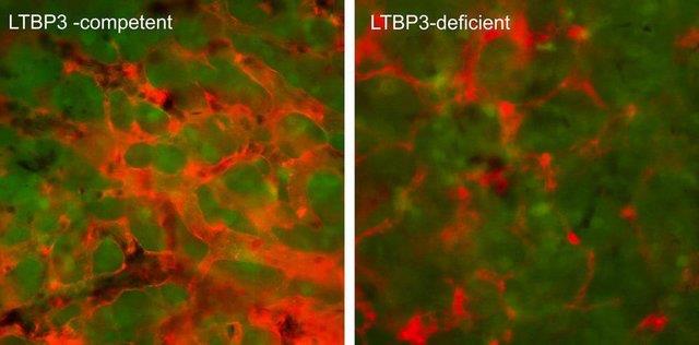  شناسایی یک پروتئین برای مبارزه با گسترش سلول‌های سرطانی