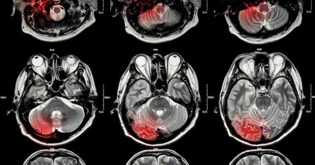 خارج کردن تومورهای مغزی با یک روش نوین